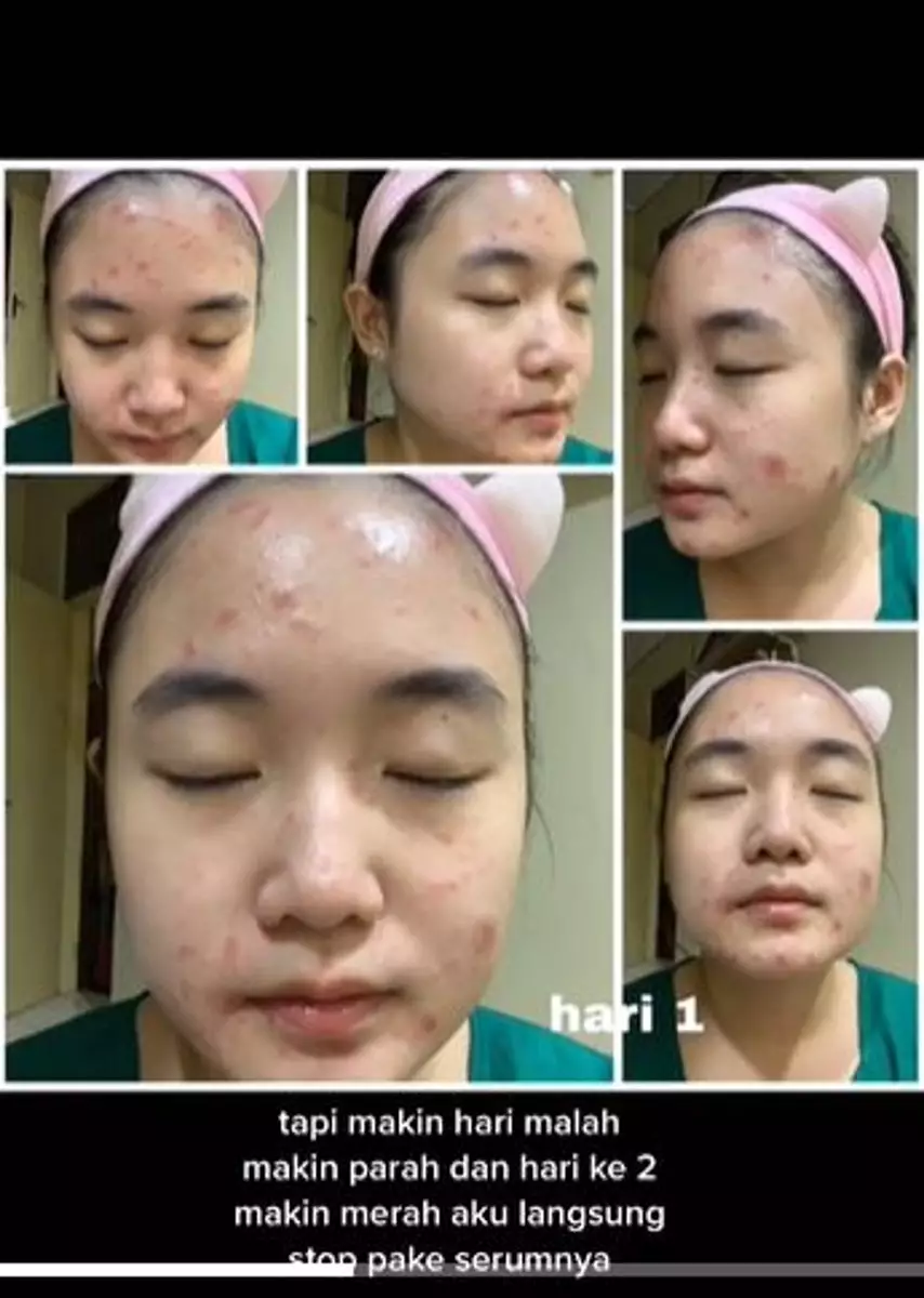 Wajah mulus cewek jadi jerawatan parah usai pakai iseng gonta ganti serum TikTok