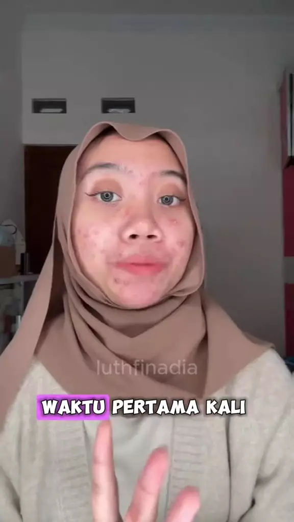 cewek ini bagikan kisahnya alami rosacea © 2024 TikTok cewek ini bagikan kisahnya alami rosacea © 2024 TikTok