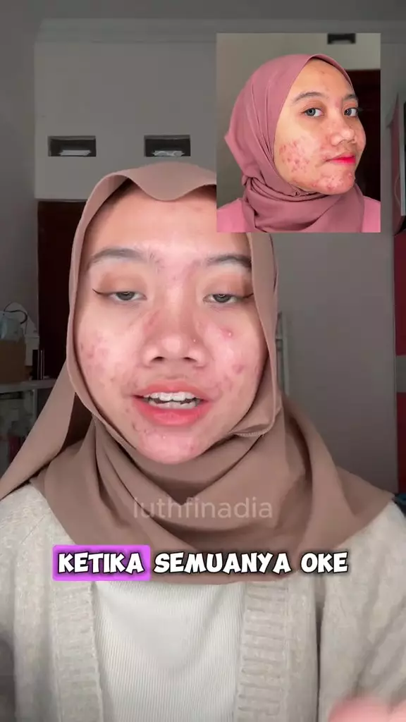cewek ini bagikan kisahnya alami rosacea © 2024 TikTok cewek ini bagikan kisahnya alami rosacea © 2024 TikTok