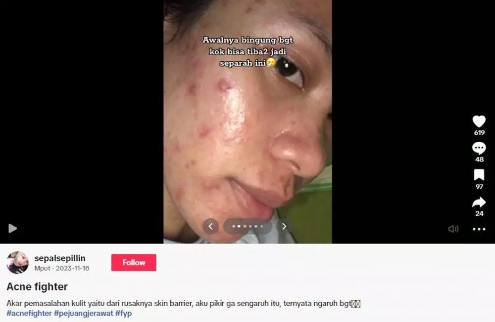 Cewek ini alami breakout di wajahnya efek over eksfoliasi TikTok Cewek ini alami breakout di wajahnya efek over eksfoliasi TikTok