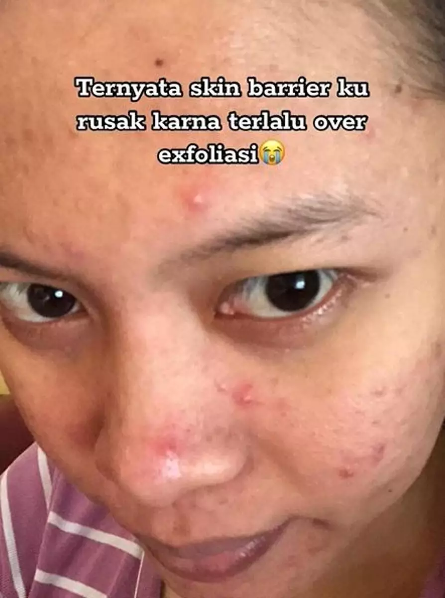 Cewek ini alami breakout di wajahnya efek over eksfoliasi TikTok Cewek ini alami breakout di wajahnya efek over eksfoliasi TikTok