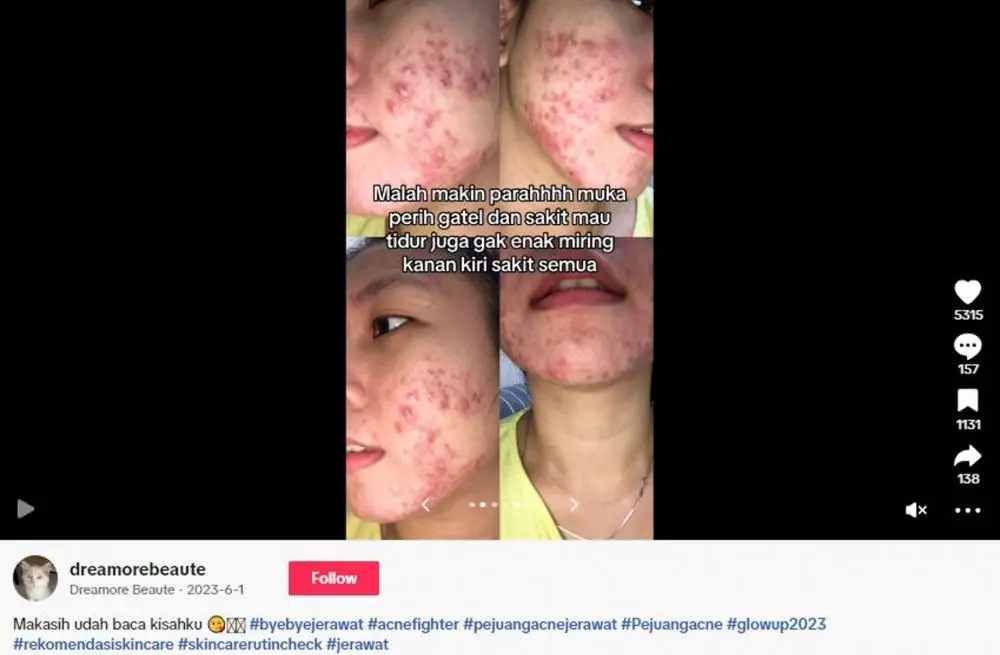 Cewek alami breakout karena faktor hormonal bagikan cara mengatasinya TikTok