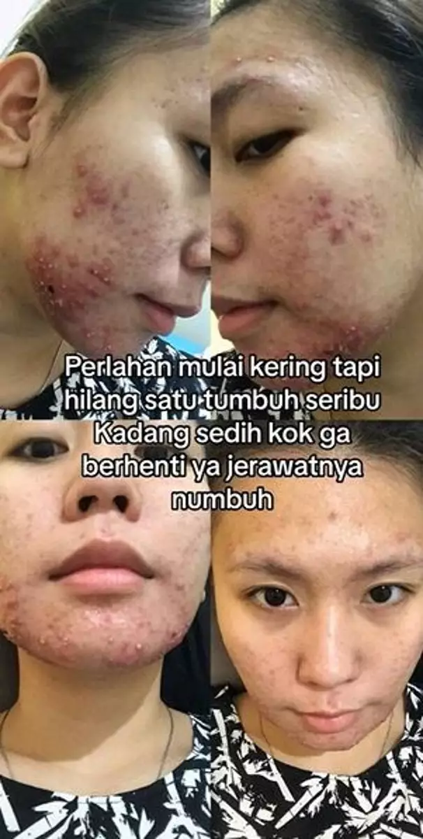 Cewek alami breakout karena faktor hormonal bagikan cara mengatasinya TikTok