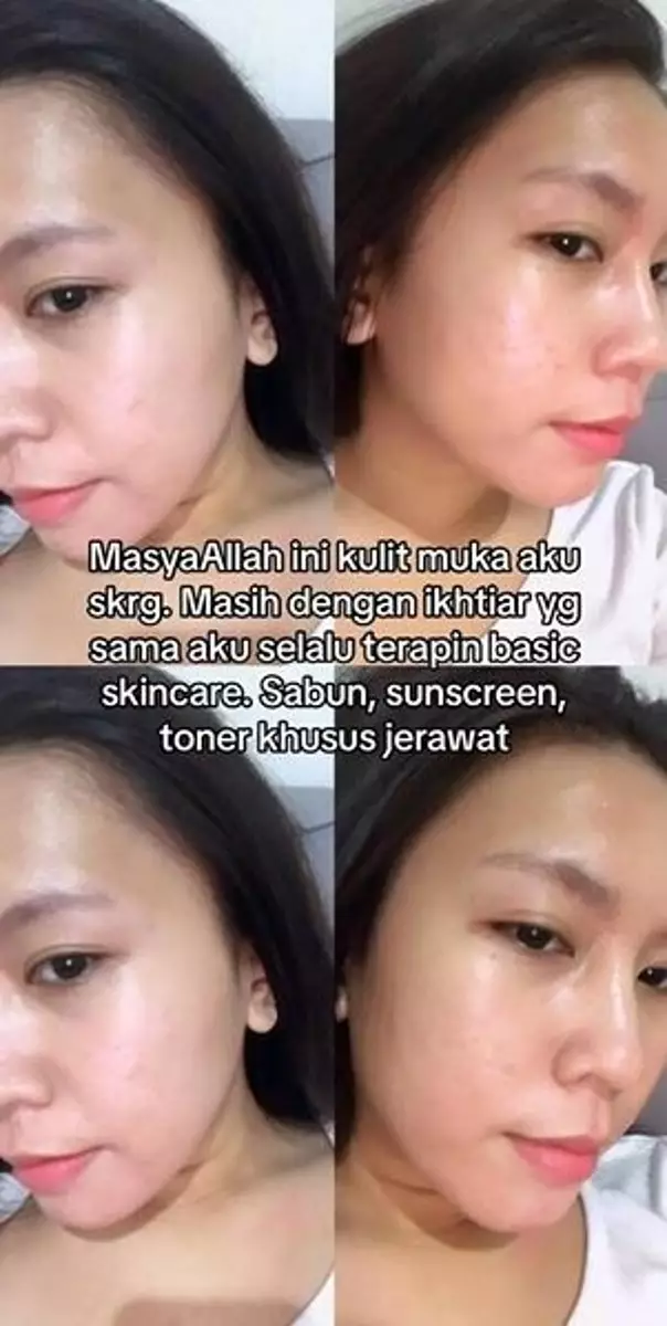 Cewek alami breakout karena faktor hormonal bagikan cara mengatasinya TikTok