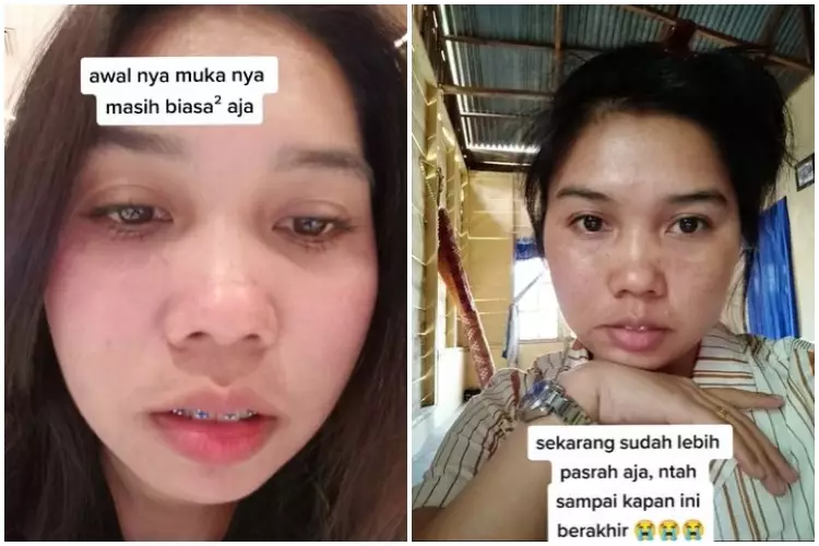 Wajah cewek penuh flek hitam akibat gonta-ganti skincare TikTok Wajah cewek penuh flek hitam akibat gonta-ganti skincare TikTok