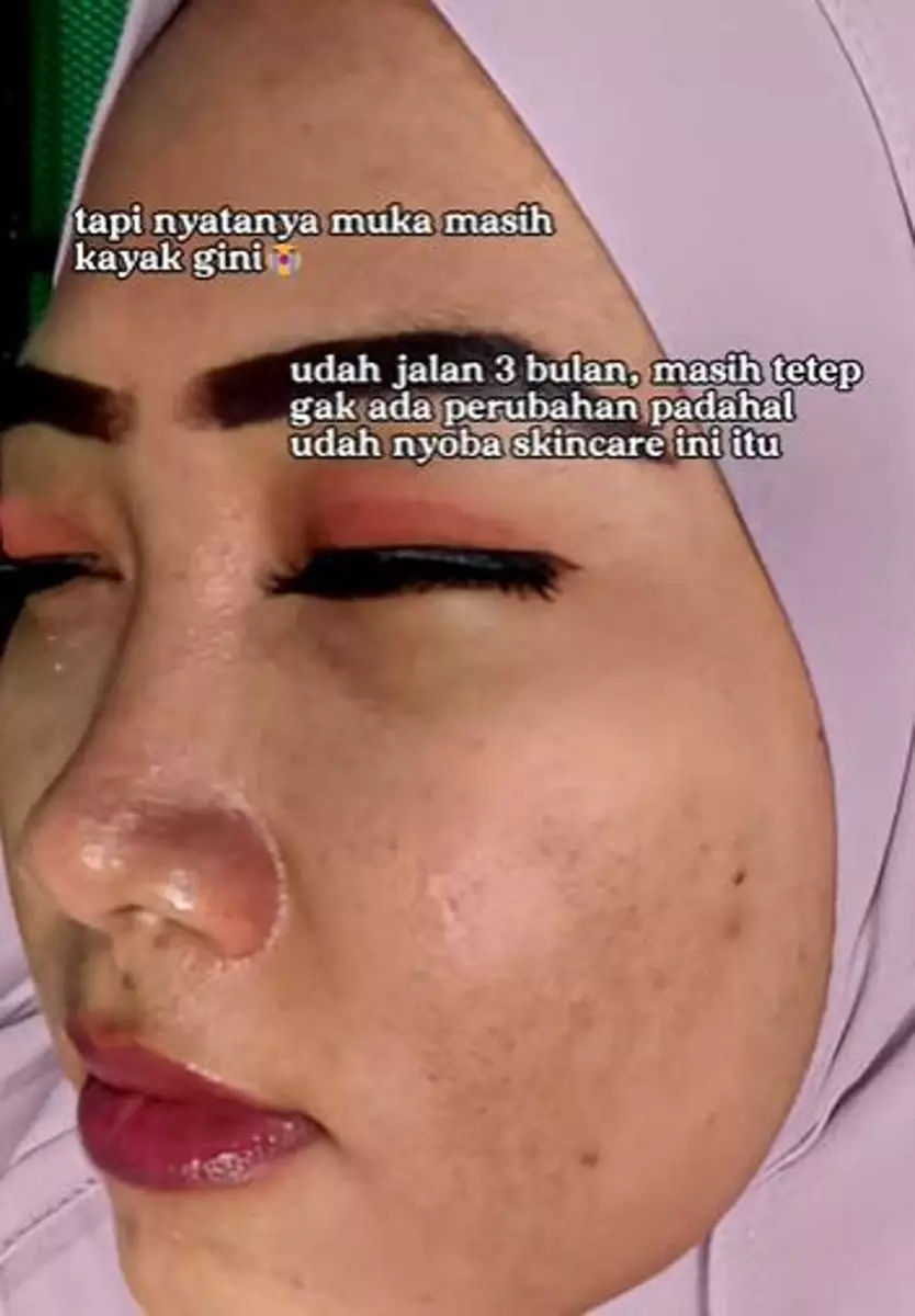Kisah cewek atasi flek hitam sampai wajah jadi mulus TikTok