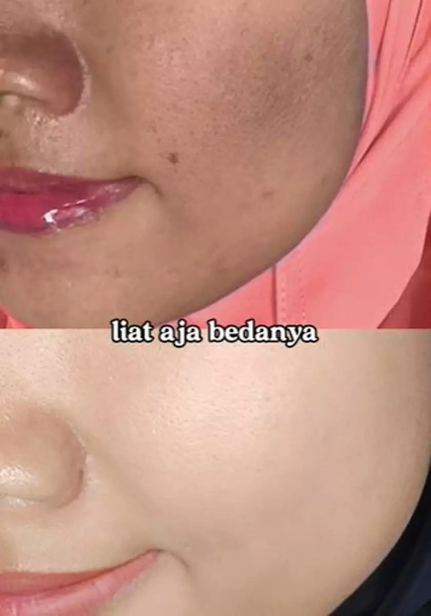 Kisah cewek atasi flek hitam sampai wajah jadi mulus TikTok