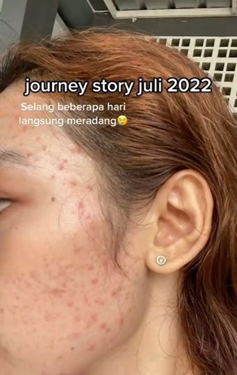 Kisah cewek sembuh dari jerawat hormonal ini penuh perjuangan TikTok
