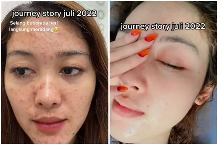 Kisah cewek sembuh dari jerawat hormonal ini penuh perjuangan TikTok