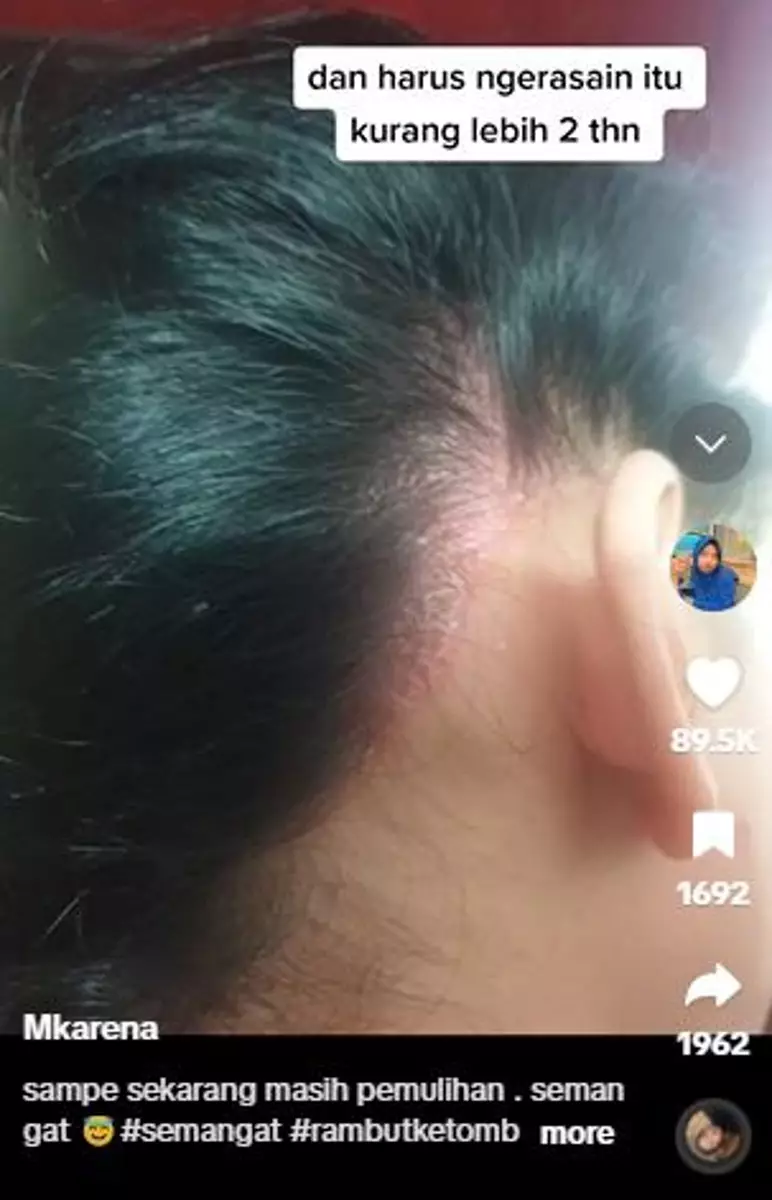 Kisah rambut cewek dipotong botak akibat ketombe TikTok
