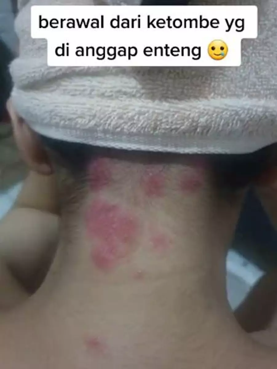 Kisah rambut cewek dipotong botak akibat ketombe TikTok