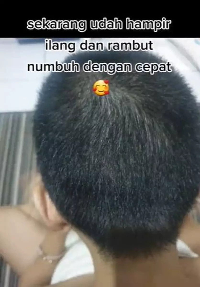 Kisah rambut cewek dipotong botak akibat ketombe TikTok