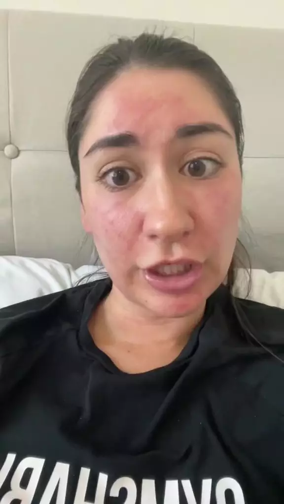 reaksi alergi sunscreen. © 2024 TikTok reaksi alergi sunscreen. © 2024 TikTok