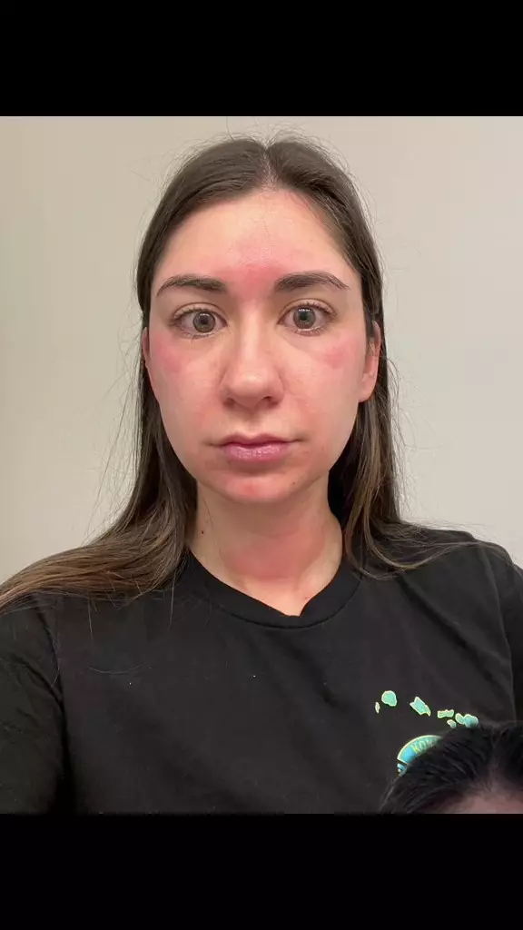 reaksi alergi sunscreen. © 2024 TikTok reaksi alergi sunscreen. © 2024 TikTok