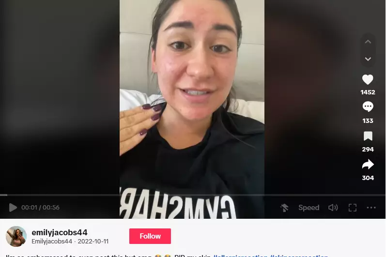 reaksi alergi sunscreen. © 2024 TikTok reaksi alergi sunscreen. © 2024 TikTok