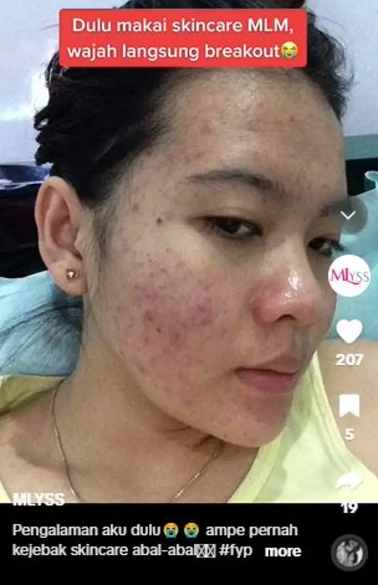 Kisah cewek sembuhkan beruntusan di wajah akibat skincare abal-abal TikTok Kisah cewek sembuhkan beruntusan di wajah akibat skincare abal-abal TikTok