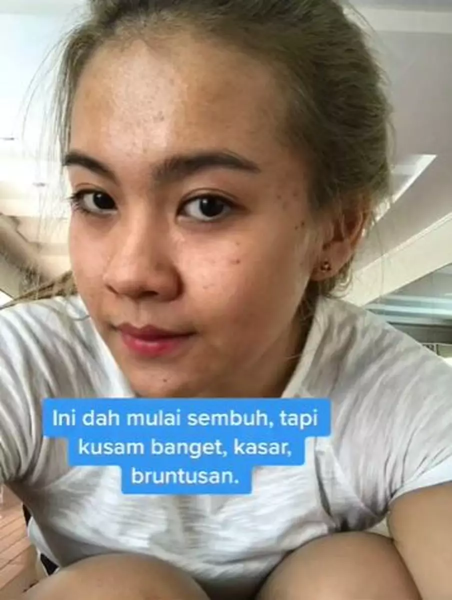 Kisah cewek sembuhkan beruntusan di wajah akibat skincare abal-abal TikTok Kisah cewek sembuhkan beruntusan di wajah akibat skincare abal-abal TikTok
