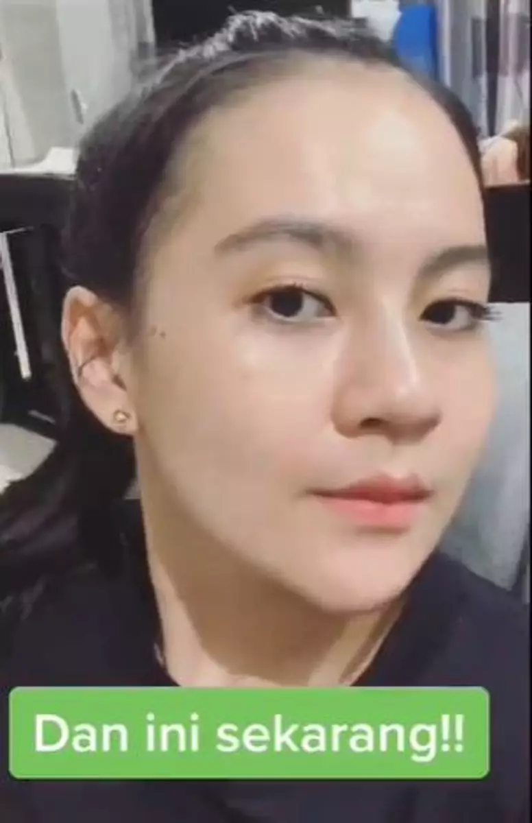 Kisah cewek sembuhkan beruntusan di wajah akibat skincare abal-abal TikTok Kisah cewek sembuhkan beruntusan di wajah akibat skincare abal-abal TikTok