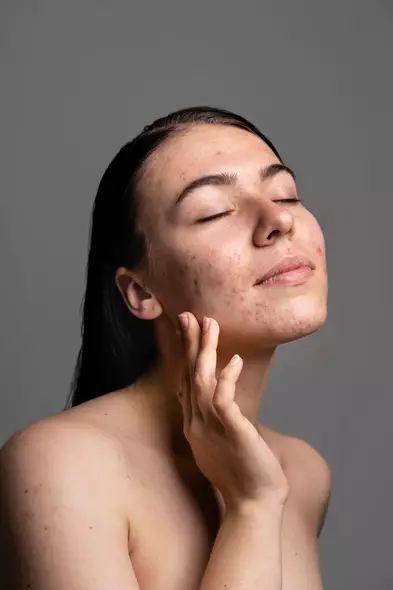  skincare bisa menghilangkan bopeng di wajah © 2024 freepik.com