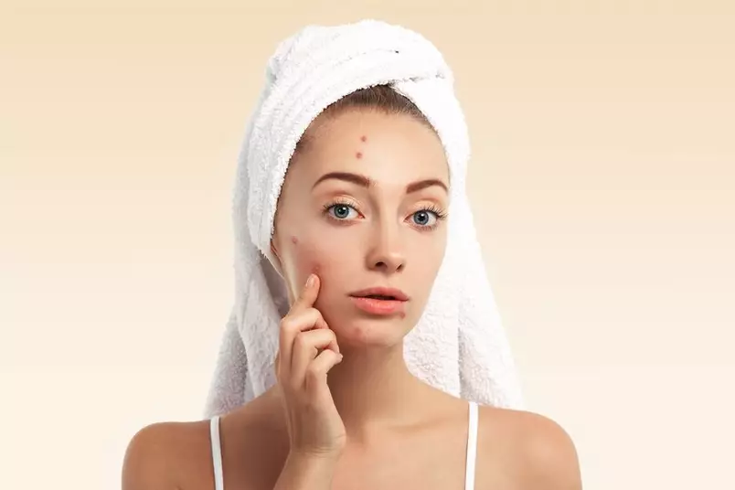 ciri jerawat karena tidak cocok skincare © 2024 freepik.com