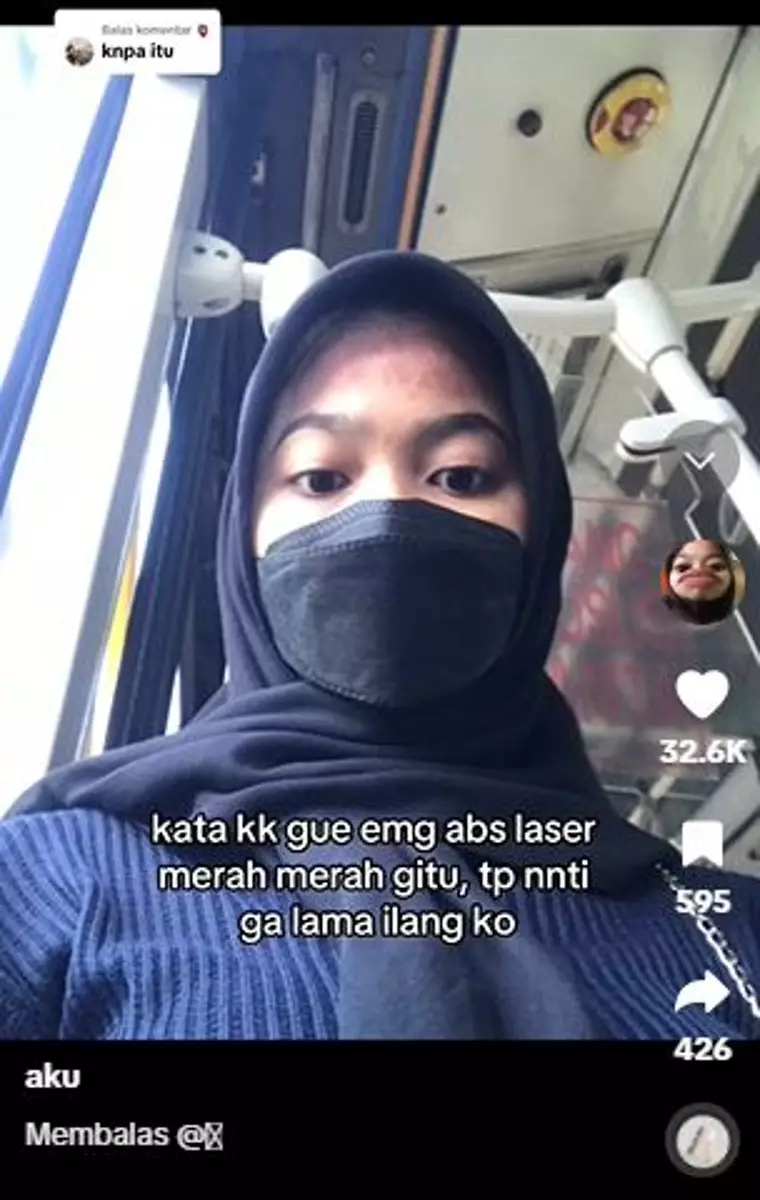 Lakukan laser wajah hilangkan bekas jerawat dan beruntusan malah jidat belang TikTok Lakukan laser wajah hilangkan bekas jerawat dan beruntusan malah jidat belang TikTok