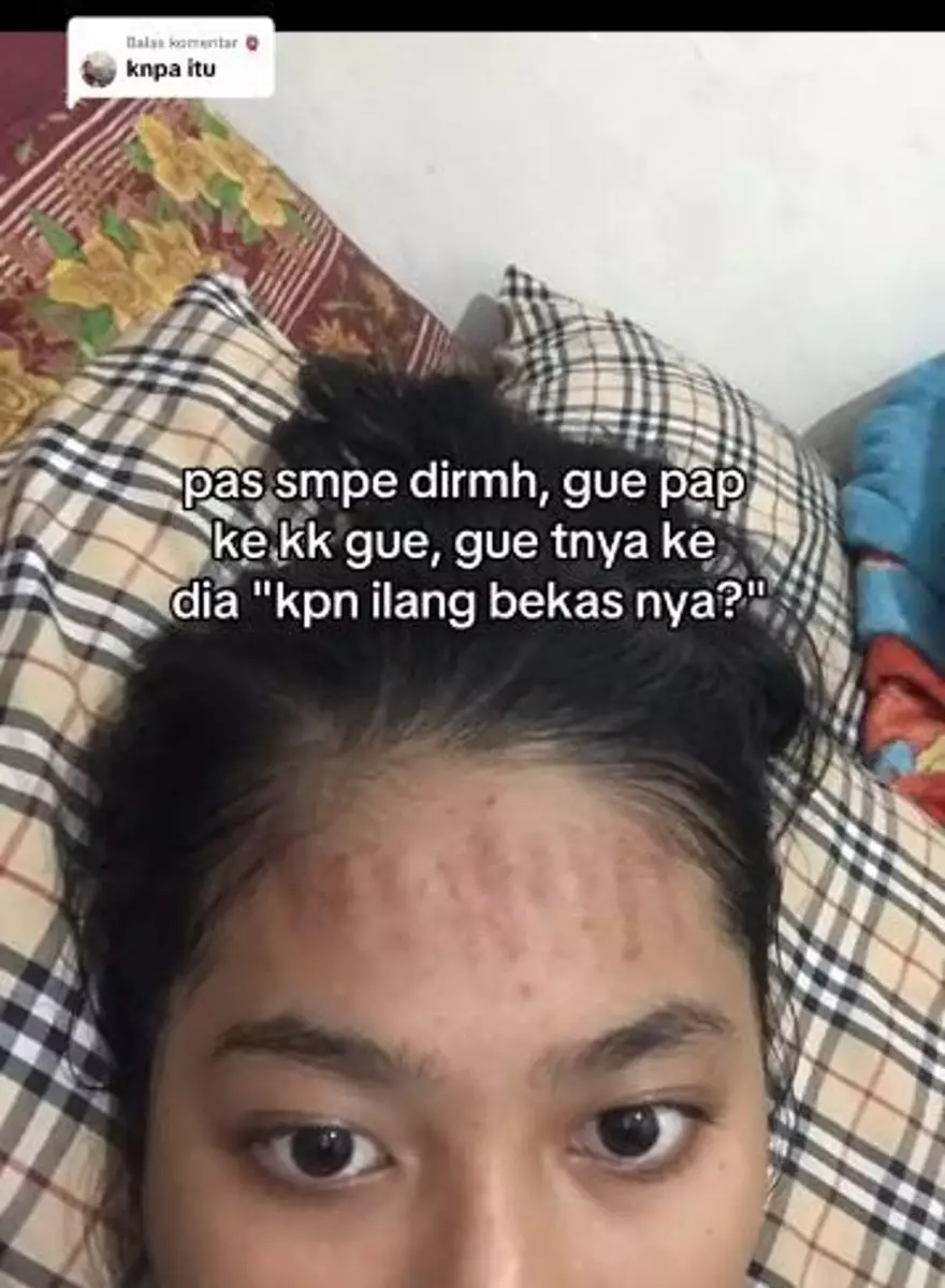 Lakukan laser wajah hilangkan bekas jerawat dan beruntusan malah jidat belang TikTok Lakukan laser wajah hilangkan bekas jerawat dan beruntusan malah jidat belang TikTok