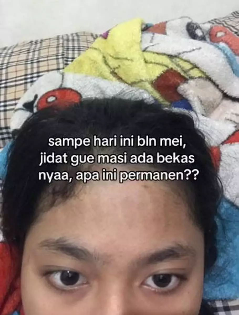 Lakukan laser wajah hilangkan bekas jerawat dan beruntusan malah jidat belang TikTok Lakukan laser wajah hilangkan bekas jerawat dan beruntusan malah jidat belang TikTok