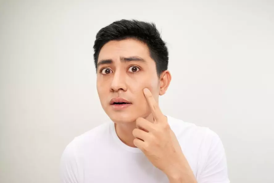 menghilangkan bercak putih di wajah pakai skincare © 2024 freepik.com