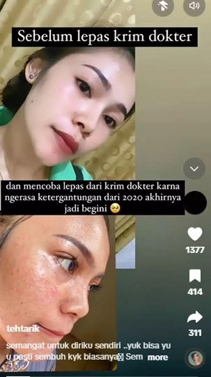 Efek pakai skincare kandungan steroid wajah breakout TikTok Efek pakai skincare kandungan steroid wajah breakout TikTok