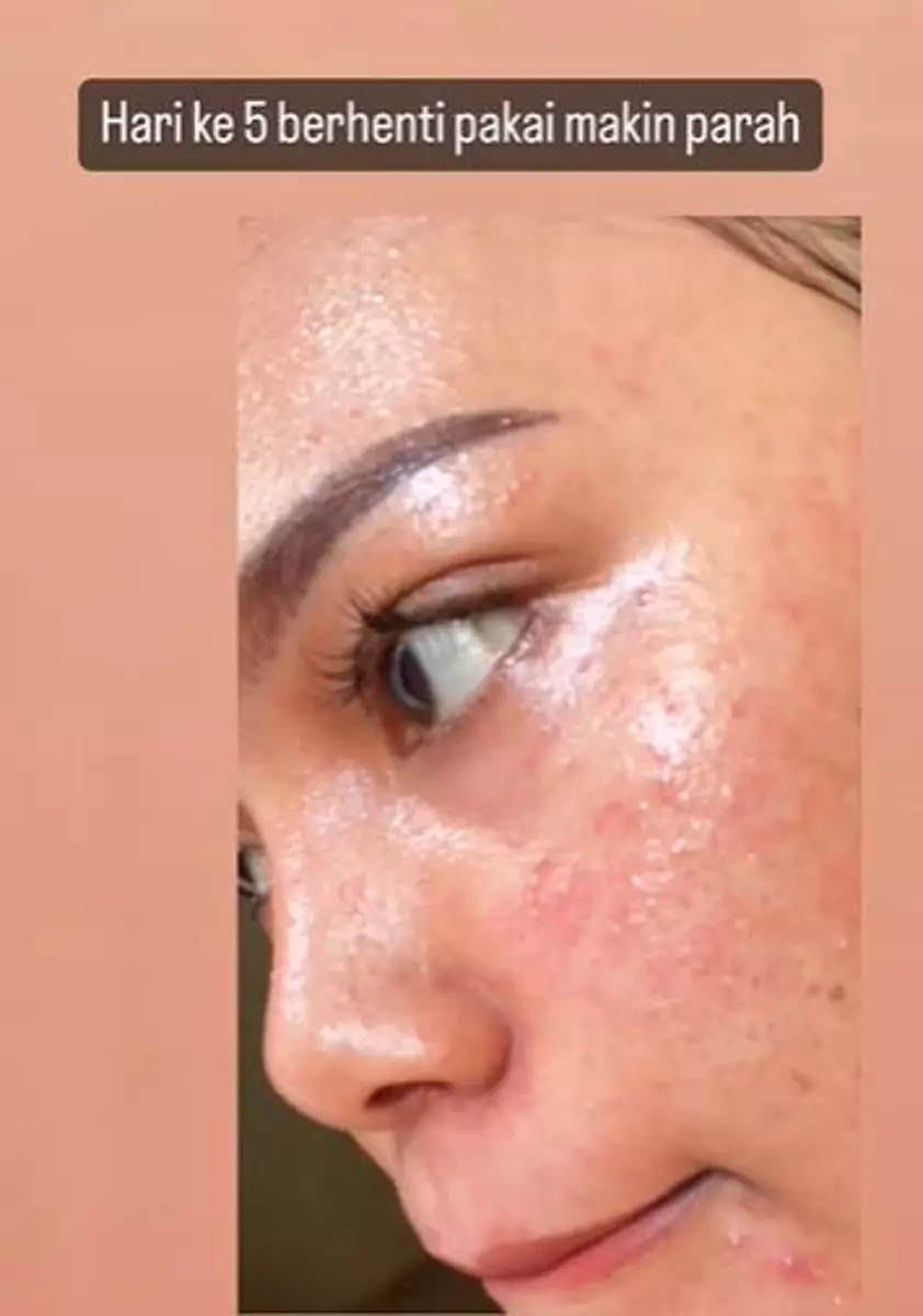 Efek pakai skincare kandungan steroid wajah breakout TikTok Efek pakai skincare kandungan steroid wajah breakout TikTok