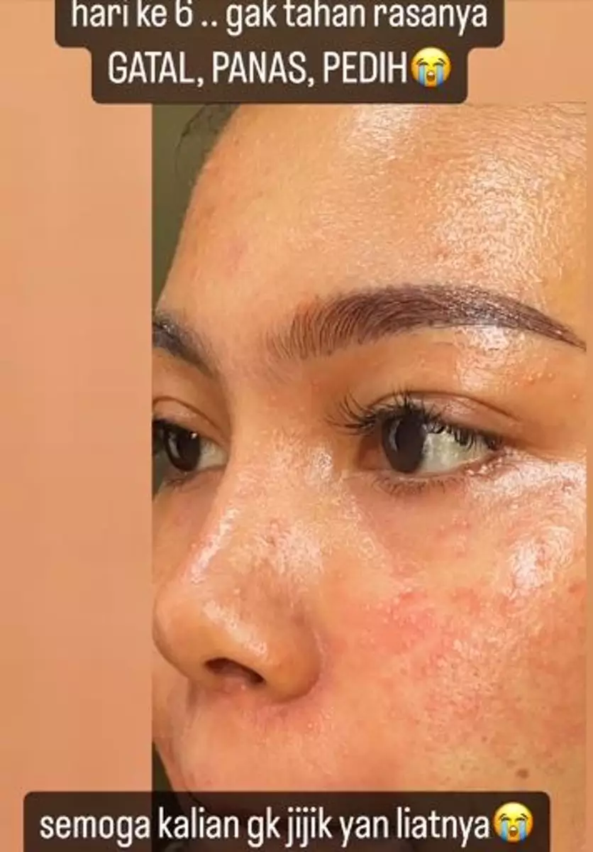 Efek pakai skincare kandungan steroid wajah breakout TikTok Efek pakai skincare kandungan steroid wajah breakout TikTok