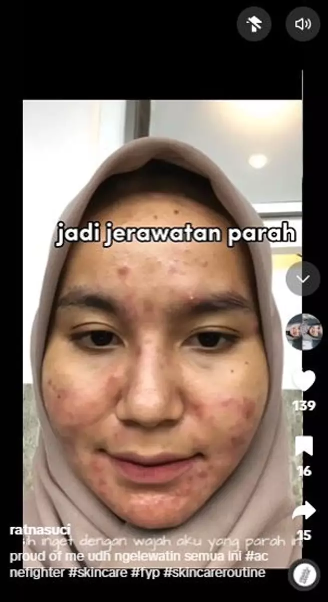 Perjuangan cewek sembuh dari jerawat menginspirasi TikTok