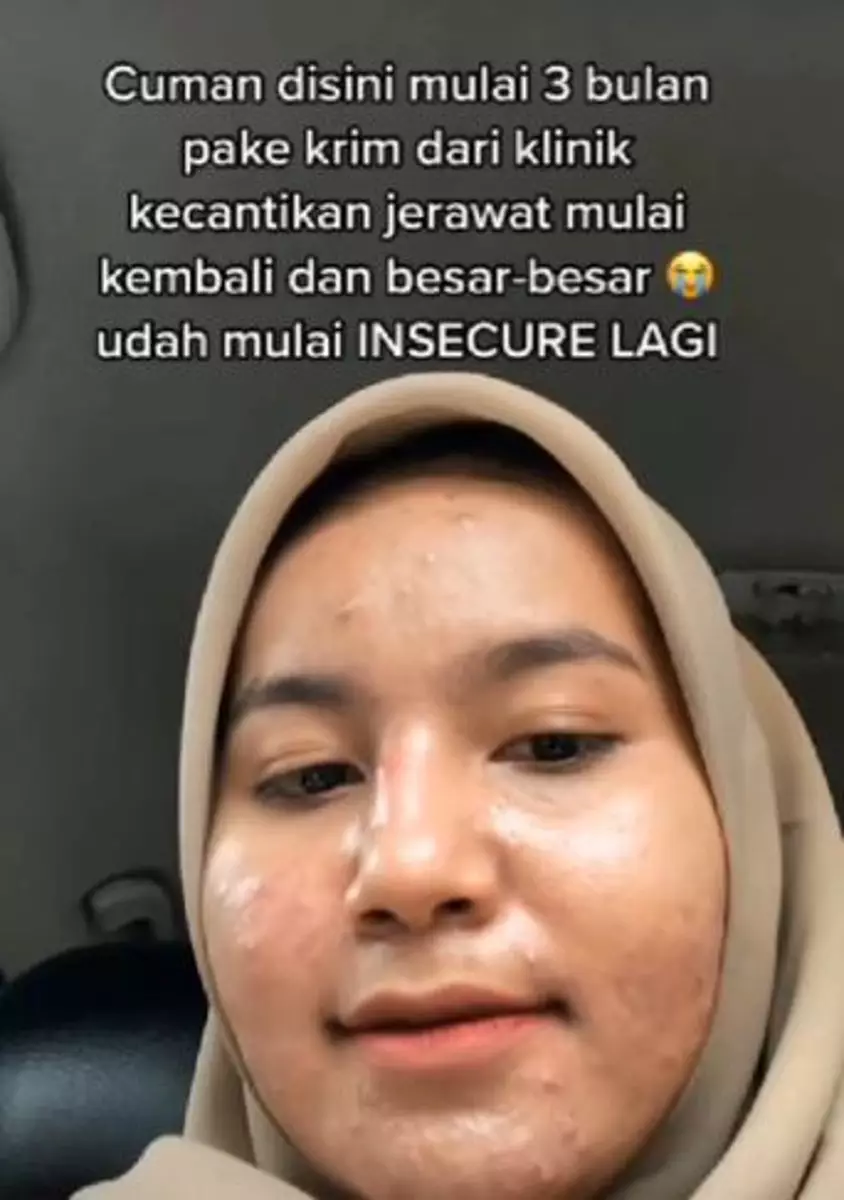 Perjuangan cewek sembuh dari jerawat menginspirasi TikTok