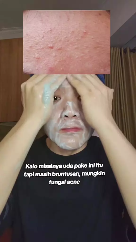 sampo antiketombe atasi fungal acne © 2024 freepik.com sampo antiketombe atasi fungal acne © 2024 freepik.com