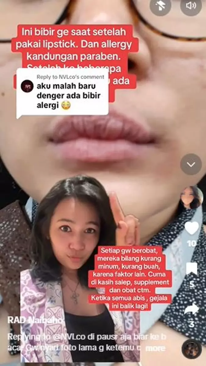 Kisah cewek bibirnya bengkak sampai berdarah akibat alergi lipstik TikTok