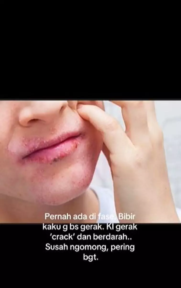 Kisah cewek bibirnya bengkak sampai berdarah akibat alergi lipstik TikTok