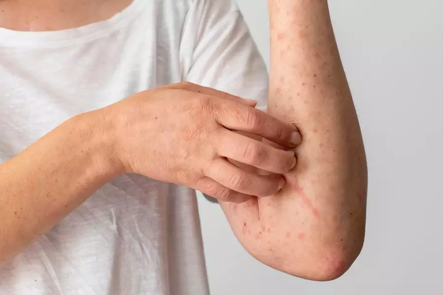 Apa itu keratosis pilaris © 2024 f