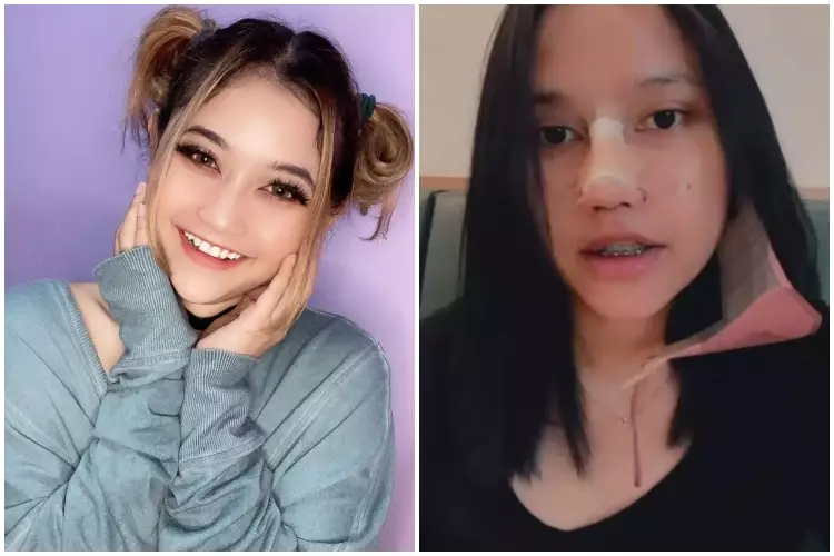 7 Potret before after selebgram usai oplas ini manglingi Berbagai sumber