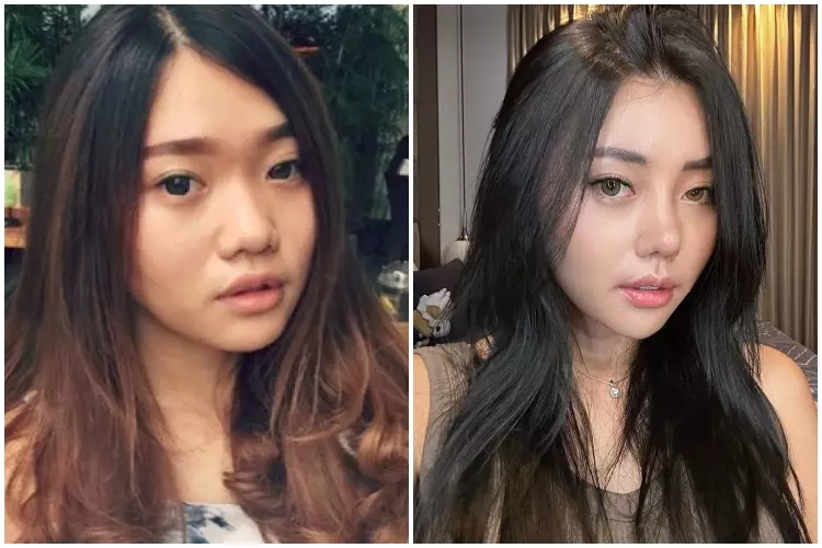 7 Potret before after selebgram usai oplas ini manglingi Berbagai sumber