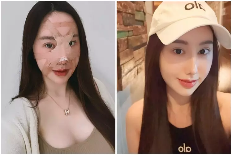 7 Potret before after selebgram usai oplas ini manglingi Berbagai sumber