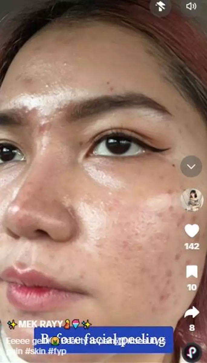 Perubahan wajah cewek sebelum dan usai treatment facial peeling TikTok