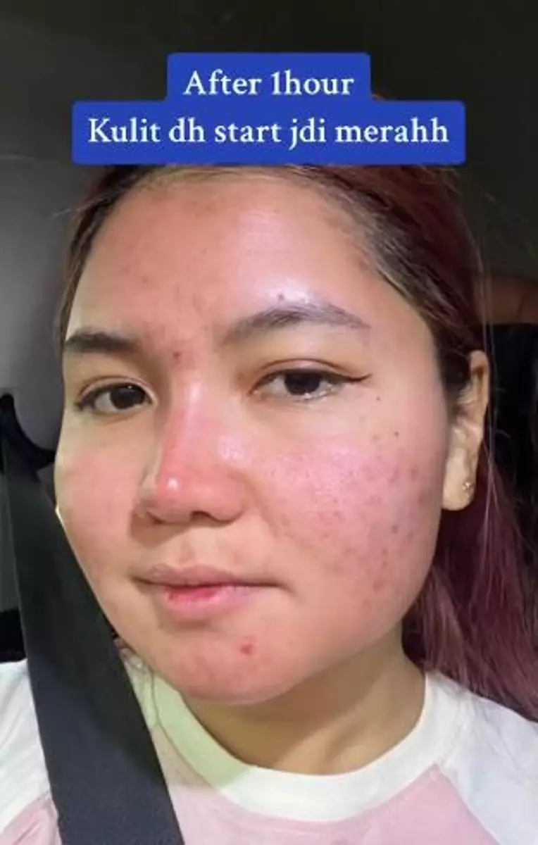 Perubahan wajah cewek sebelum dan usai treatment facial peeling TikTok