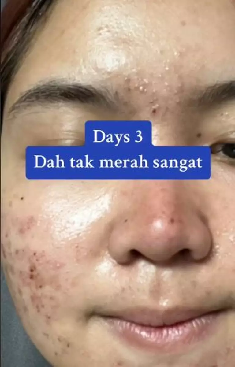 Perubahan wajah cewek sebelum dan usai treatment facial peeling TikTok