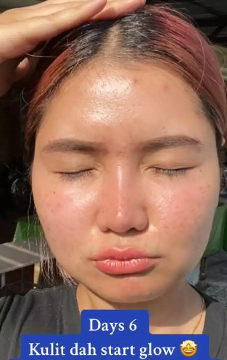 Perubahan wajah cewek sebelum dan usai treatment facial peeling TikTok