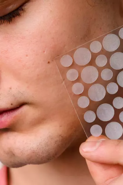 Pakai acne patch sebelum atau sesudah skincare © 2024 freepik.com