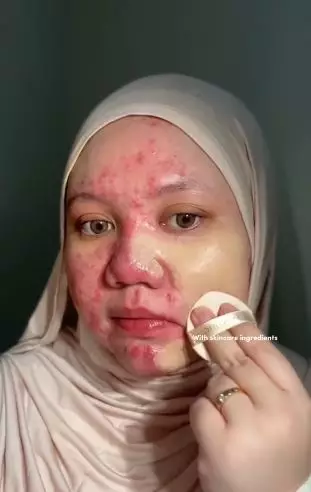 Transformasi makeup cewek wajah kemerahan penuh jerawat hasilnya auto mulus TikTok Transformasi makeup cewek wajah kemerahan penuh jerawat hasilnya auto mulus TikTok