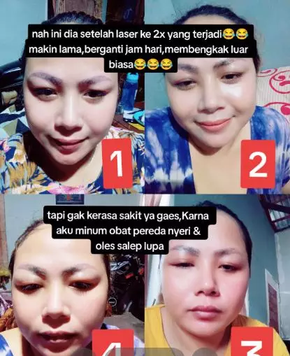 Cewek bagikan kisah sulam alis gagal dan perjuangan laser alis TikTok Cewek bagikan kisah sulam alis gagal dan perjuangan laser alis TikTok