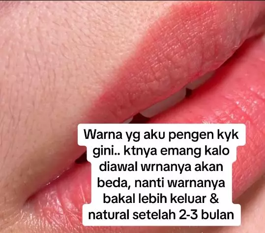 Kisah cewek usai sulam bibir ini berujung idap penyakit seumur hidup TikTok