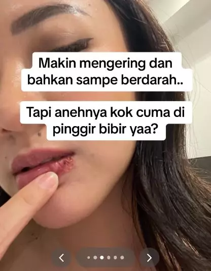 Kisah cewek usai sulam bibir ini berujung idap penyakit seumur hidup TikTok
