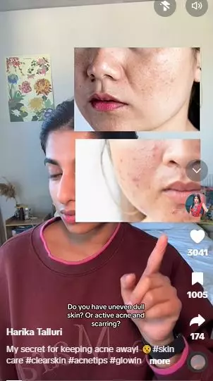 Trik atasi jerawat meradang serta bekasnya pakai 1 jenis buah Berbagai sumber